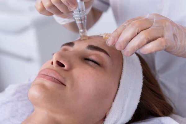 microneedling with prp treatment