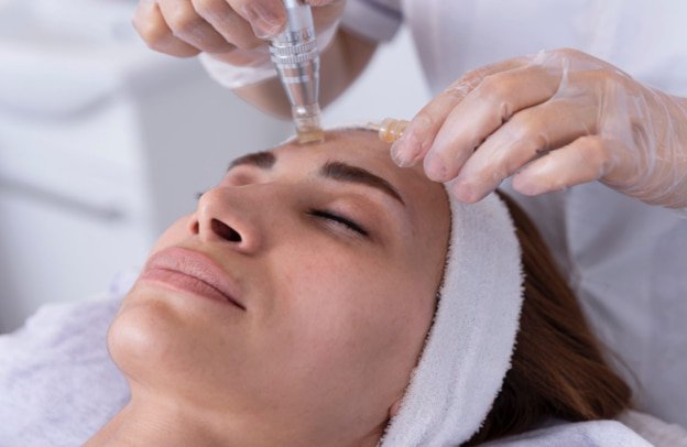 microneedling with prp treatment